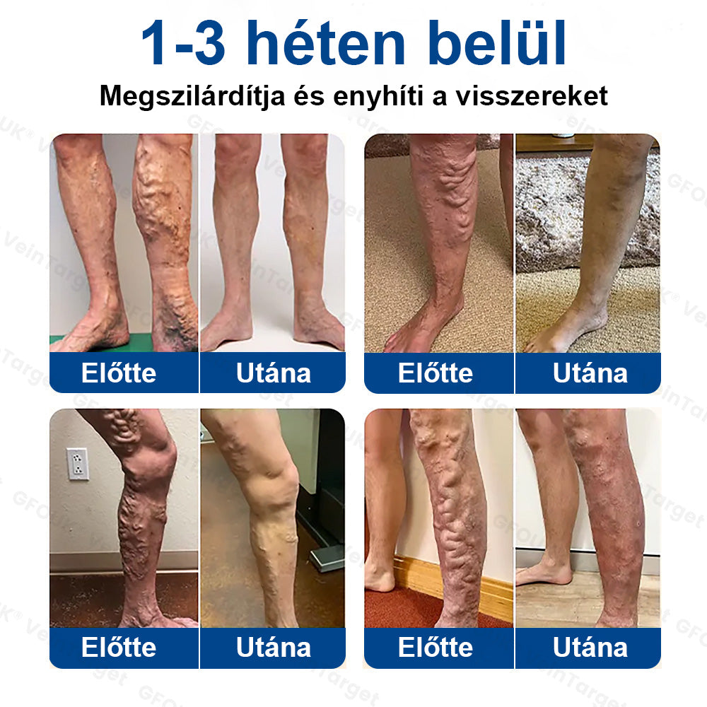 ✅Laleia® Vein Ease mikrotűs tapasz