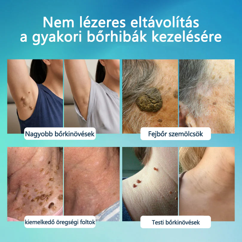 Timilk® SpotlessPro Fejlett Bőrápoló Toll-🌿