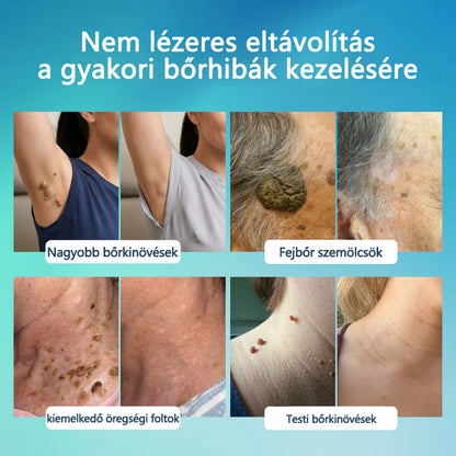 Timilk® SpotlessPro Fejlett Bőrápoló Toll-🌿