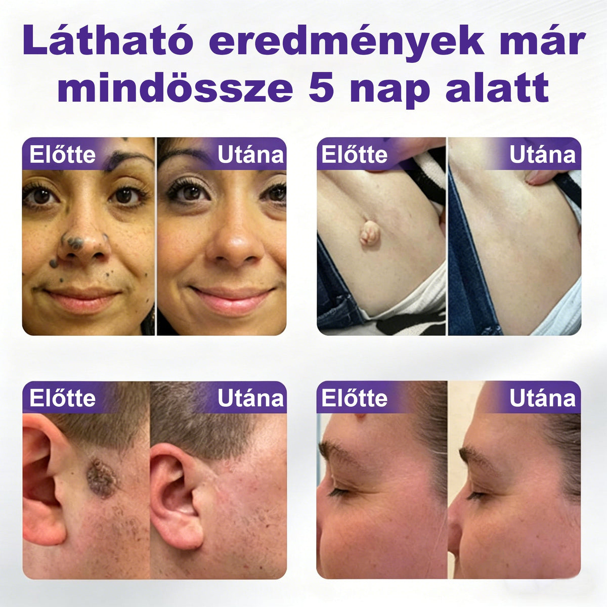 CleraNaure® mikrotűs szemölcs- és anyajegyeltávolító tapasz-🌿