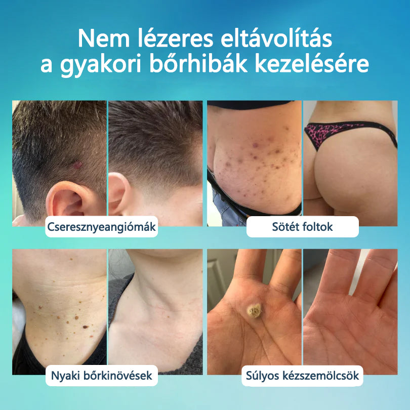 Timilk® SpotlessPro Fejlett Bőrápoló Toll-🌿