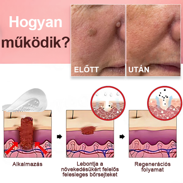 KUBOZN® Nano-mikrotűs bőrcímke-eltávolító tapaszok