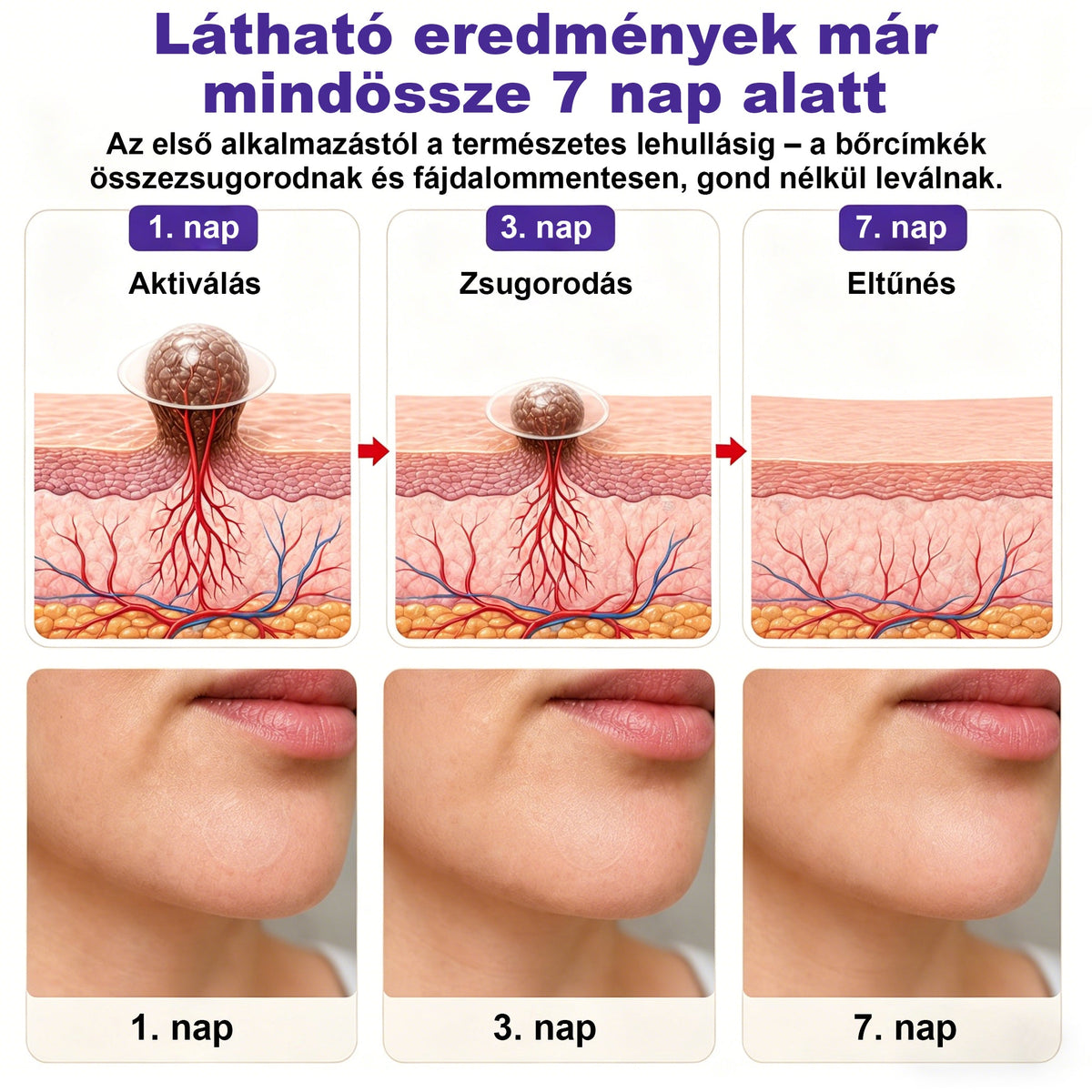 CleraNaure® mikrotűs szemölcs- és anyajegyeltávolító tapasz-🌿