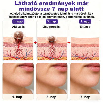 CleraNaure® mikrotűs szemölcs- és anyajegyeltávolító tapasz-🌿