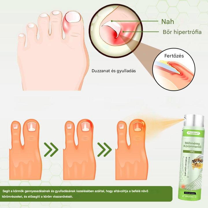 🔥A legnépszerűbb丨Korlátozott ideig 50%-os kedvezmény | Foulme® NailRescue Méhméreg Spray-📦